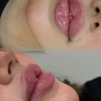 (فیلرلب وبوتاکس ومزو،آنزیم)