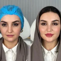 جشنواره ژل و بوتاکس ترمیم رایگان