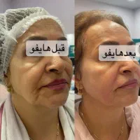 جشنواره  هایفو جوانساز  لیفت پوست