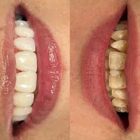 دندانپزشکی اقساطی،جشنواره کامپوزیت و لمینیت