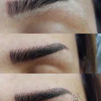 میکروبلیدینگ .فیبروز . نانوبولدبروز