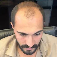 کاشت ابرو مو ریش|خدمات آرایشگری و زیبایی|گرگان, |دیوار