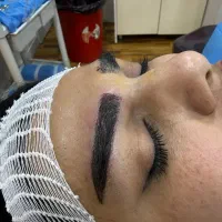 کاشت ابرو به روش جراحی و غیر جراحی