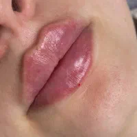 جشنواره تخفیف ژل لب، بوتاکس توسط پزشک مجرب