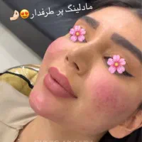 ژل و بوتاکس