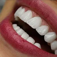 کامپوزیت دندان فکی ۵ ت اقساط لبه شیشه ای