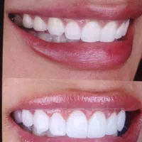 آفر ویژه کامپوزیت و لمینت