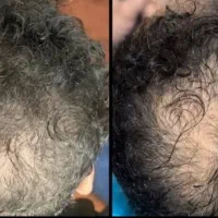 از جمع کچلا در بیا