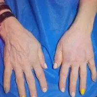 .تزریق چربی فول فیس  .ژل و بوتاکس