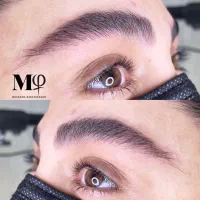 میکروبلیدینگ فیبروز
