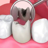 دندانسازی و دنداپزشکی ۳۰ درصد افر