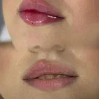 فیلر لب،چونه،گونه،فول فیس،باسن|خدمات آرایشگری و زیبایی|مشهد, سجاد شهر|دیوار