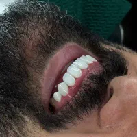 کامپوزیت بدون پیش پرداخت ۱۲ ماه/ایمپلنت/دندانپزشکی|خدمات زیبایی و سلامت|کرج, فاز ۳ گوهردشت|دیوار