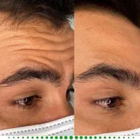 جشنواره بوتاکس وفیلر