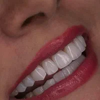 ایمپلنت فوری/روکش/کامپوزیت زیبایی/عصب کشی/|خدمات آرایشگری و زیبایی|تهران, مهران (سیدخندان)|دیوار