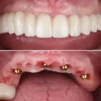 ایمپلنت دیجیتالی، دندانپزشکی با اقساط ۶۰ ماهه