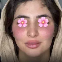 ژل،بوتاکس،مزوتراپی،مزونیدلینگ|خدمات آرایشگری و زیبایی|دوگنبدان, |دیوار