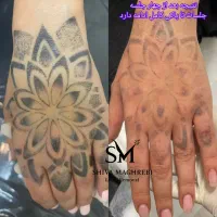 پاک کردن انواع تتو و خالکوبی