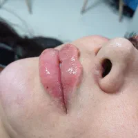 آموزش و تزریق ژل و بوتاکس و پیرسینگ