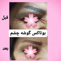 کلینیک لیزربوتاکس مزو دکترعلی حسین‌ زاده پرندبیمه|خدمات آرایشگری و زیبایی|پرند, |دیوار
