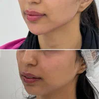 فیلر نزن اول ببین کجای چهره‌ات نیاز به تغییر داره