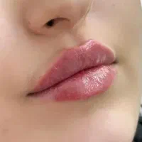 جشنواره ژل،بوتاکس،فیلر،انزیم و خالبرداری