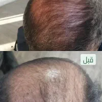 درمان کم پشتی و تاسی بدون کاشت