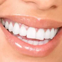 کامپوزیت بدون تراش دندان فکی ۶میلیون