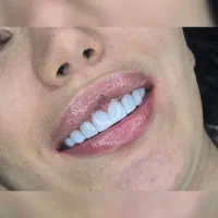 دندانپزشکی. کامپوزیت. عصب‌کشی. پرکردن.ترمیم