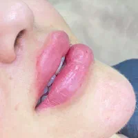 تزریق ژل صورت