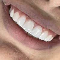 تخفیف ۵۰ درصدی کامپوزیت فکی ۷۹۰۰