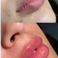 تزریق ژل و بوتاکس با قیمت استثنایی/ژل 890بوتاکس750