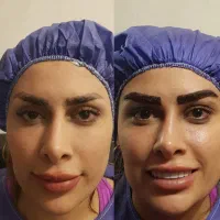 جشنواره ویژه کاشت مو ۱۹.کاشت ابرو ۱۴.کاشت ریش ۱۹