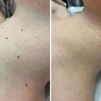 خالبرداری ،رفع کک ومک ،برداشتن میخچه توسط پزشک