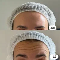 بوتاکس مصپورت اصل تزریق توسط پزشک در کلینیک