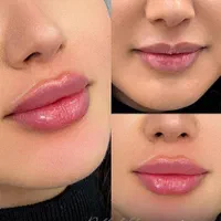 جشنواره ژل بوتاکس پی ارپی مزو نخ در مطب