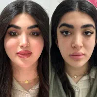 تزریق تخصصی ژل وبوتاکس،هایفو،پاک کردن تتوتوسط پزشک|خدمات آرایشگری و زیبایی|کرمانشاه, |دیوار