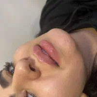 مزو،ژل،لیفت نخ،هایفو،بوتاکس توسط دکتریوسف پور