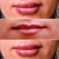 ژل و بوتاکس|خدمات آرایشگری و زیبایی|تهران, تهرانسر شمالی|دیوار