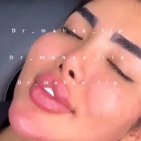 پزشک زیبایی تزریق ژل گونه فیلرچانه لب روسی مادلینگ|خدمات آرایشگری و زیبایی|تهران, پونک|دیوار