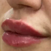 تخفیف ژل لب زاویه فک بوتاکس،لیفت بانخ،مزووایت