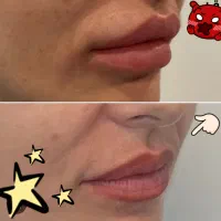 تزریق رایگان آنزیم ژل لب و فیلر