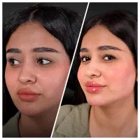 ژل بوتاکس پی ار پی توسط پزشک|خدمات آرایشگری و زیبایی|شاهین‌شهر, فردوسی|دیوار