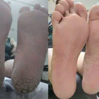 پدیکور و کفسابی درمانی تخصصی و حرفه ای