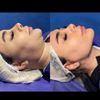 فیلر بیکینی ، لابیا پلاستی ترانسفر باسن بایوفیلر|خدمات آرایشگری و زیبایی|اندیشه, اندیشه فاز ۱|دیوار