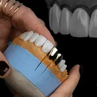 ایمپلنت قسطی لمینت عصبکشی روکش دندانپزشکی اقساطی