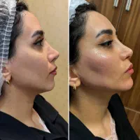 معماری صورت با فیلر/بوتاکس/پی ارپی/سلول های بنیادی|خدمات آرایشگری و زیبایی|تبریز, |دیوار