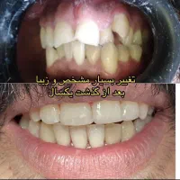ارتودنسی کامپوزیت لمینت دندان‌مصنوعی ایمپلنت|خدمات آرایشگری و زیبایی|تهران, سلسبیل شمالی|دیوار