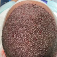 کاشت موی طبیعی وقابل رشد به روش FIT