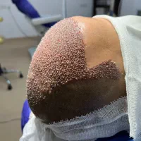 کاشت مو